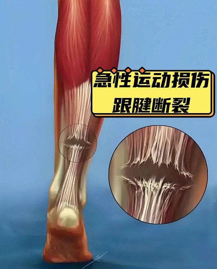 乐鱼体育官方入口-10个月康复已算快!跟腱撕裂为什么是竞技体育的“阿喀琉斯之踵”